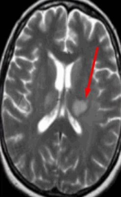 Опухоль головного мозга на МРТ
