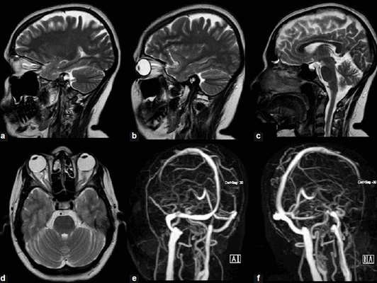 Покажет ли МРТ атеросклероз сосудов