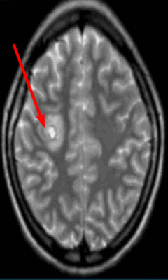 Абсцесс головного мозга на МРТ