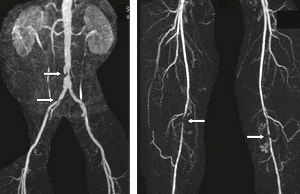Признаки атеросклероза 