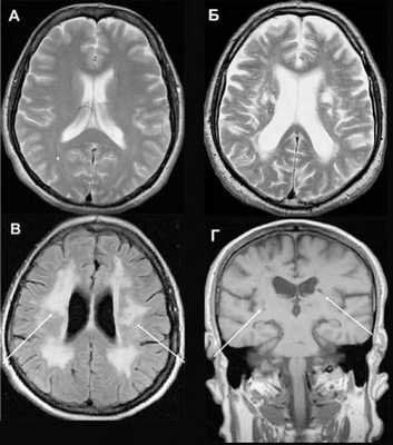 Картинки по запросу Деменция МРТ