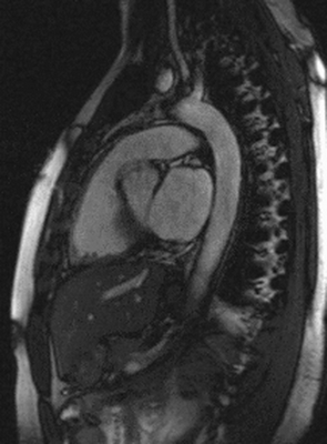 МРТ грудной клетки