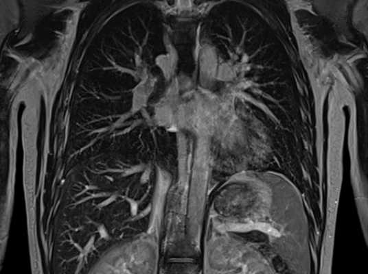 МРТ грудной клетки
