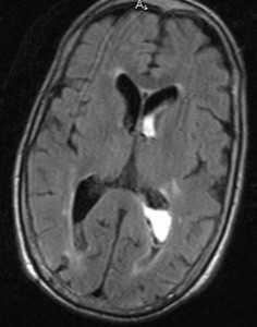 внутрижел кровоизл