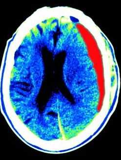 субдуральная гематома