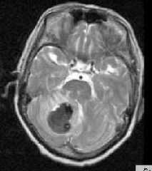 геморрагический инсульт