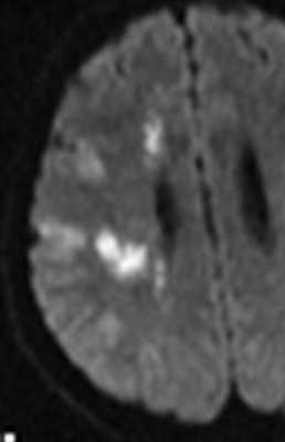 вазоспазм при САК