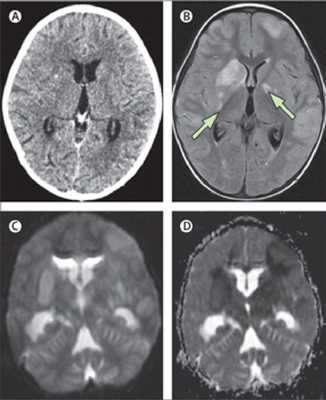 Каким бывает менингит? Менингит и его виды