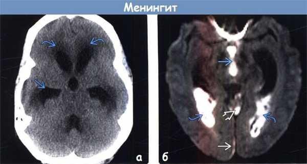 Менингит на КТ, МРТ