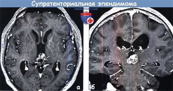 Супратенториальная эпендимома на МРТ