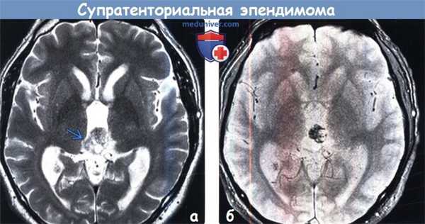 Супратенториальная эпендимома на МРТ