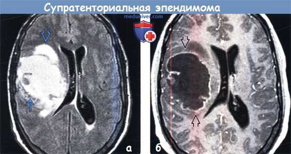 Супратенториальная эпендимома на МРТ