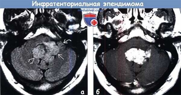 Инфратенториальная эпендимома на МРТ
