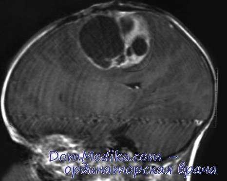 нейроэктодермальные опухоли детей