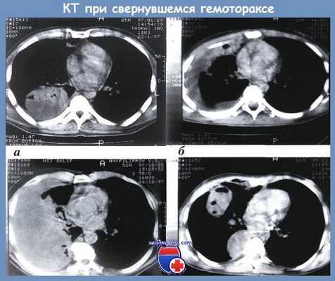 КТ при свернувшемся гемотораксе