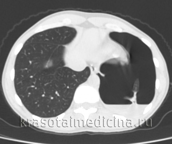 Гемоторакс