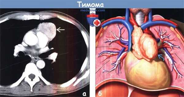 Тимома на КТ