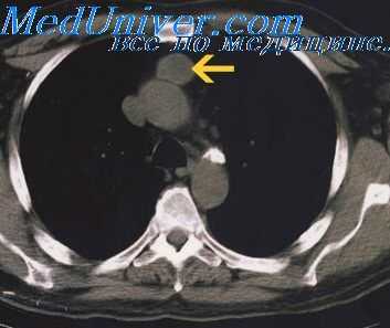 диагностика тимом