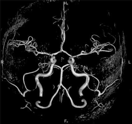 кт артерий головного мозга