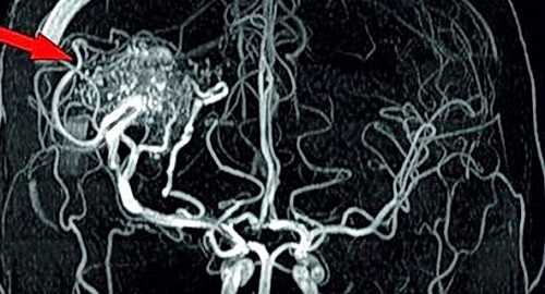 Артерио-венозная мальформация