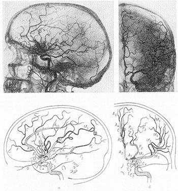 ангиография интракраниальных артерий