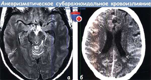 Субарахноидальное кровоизлияние из-за разрыва аневризмы на КТ, МРТ