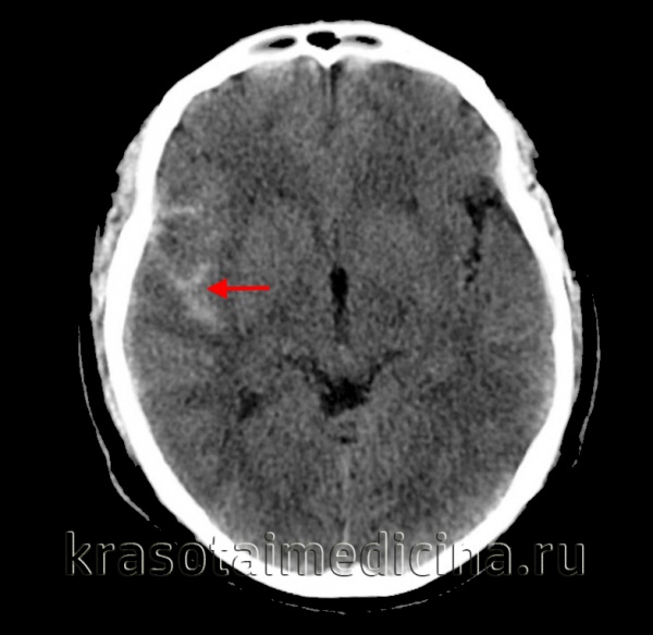 Субарахноидальное кровоизлияние