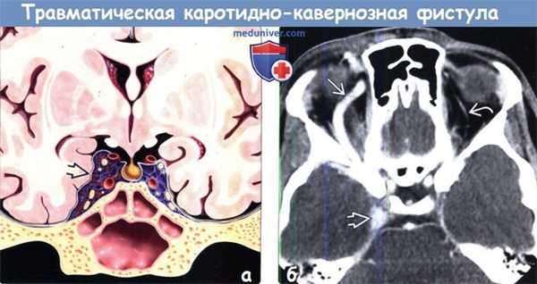Травматическая каротидно-кавернозная фистула на КТ