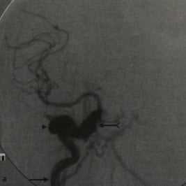 Снимки МРТ и КТ. Фистула сонной артерией и кавернозного синуса
