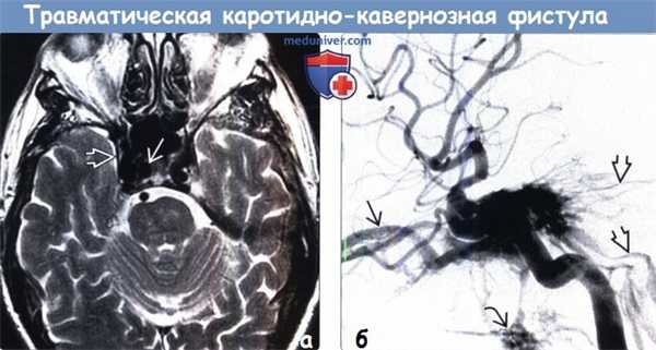 Травматическая каротидно-кавернозная фистула на МРТ, ангиограмме