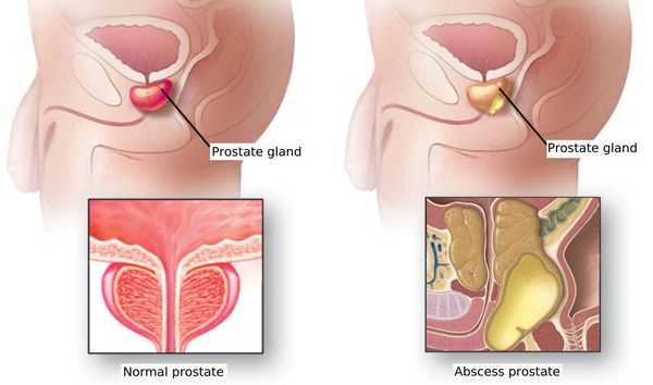Предстательная железа в норме и при абсцессе