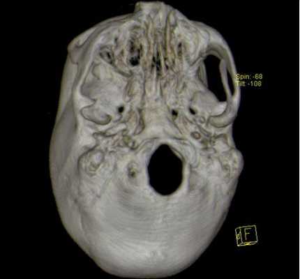 3D-реконструкция с помощью компьютерной томографии