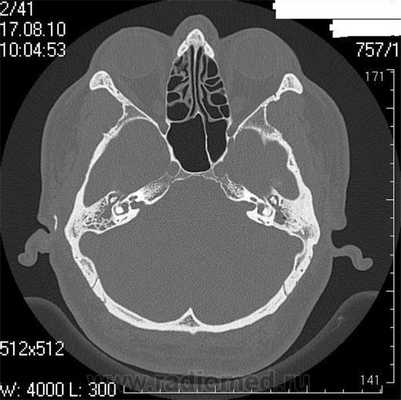Снимок (томограмма) височных костей в осевой проекции
