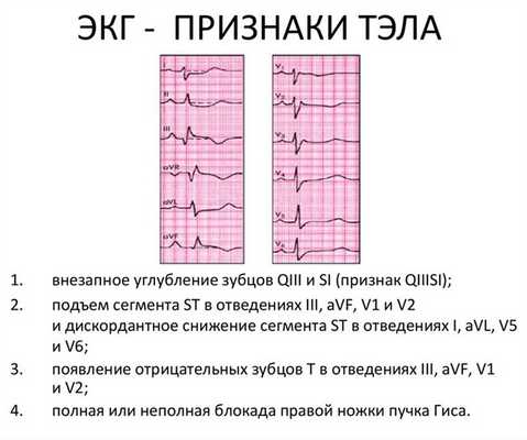 Динамика ЭКГ