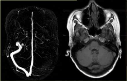  Применение МРТ в исследовании вен головного мозга
