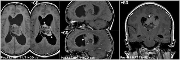 central_neurocytoma_3