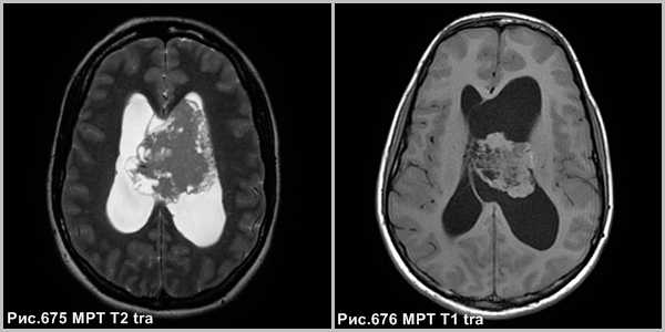 central_neurocytoma_1