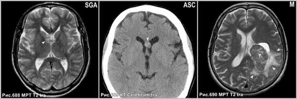 central_neurocytoma_5