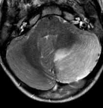церебеллит