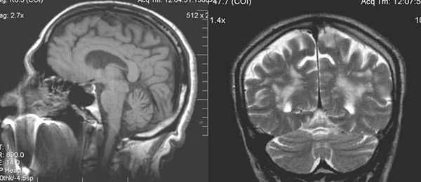 МРТ в диагностике нарушений мозгового кровообращения