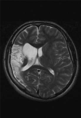 Церебральная гемиатрофия (Dyke-Davidoff-Masson syndrome)