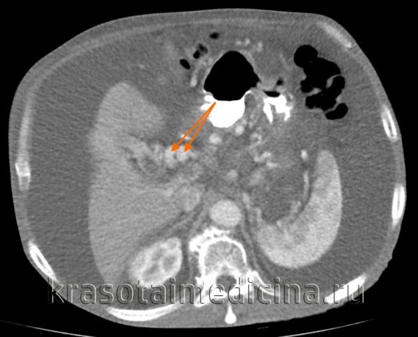 Замещение клеток печени рубцовой тканью