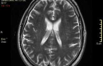 Что лучше - МРТ или КТ головного мозга