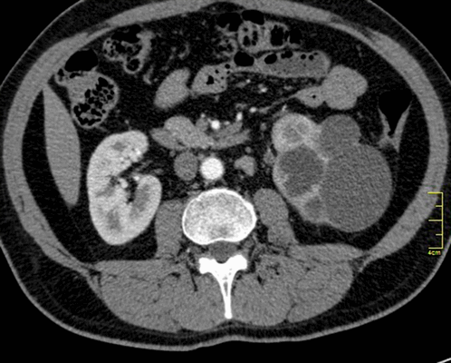 Туберкулез почки