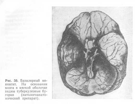 Снимки МРТ и КТ. Туберкулез ЦНС