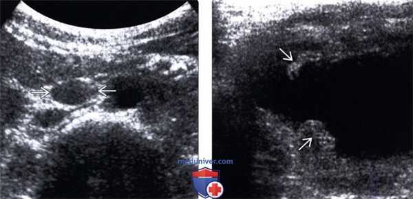УЗИ при туберкулезе почки