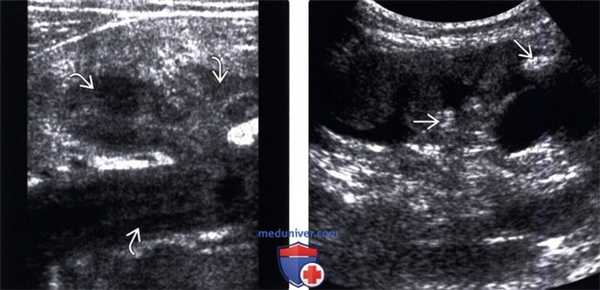 УЗИ при туберкулезе почки