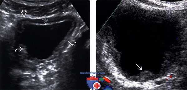 УЗИ при туберкулезе почки