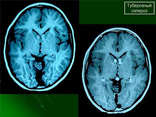 Туберозный склероз