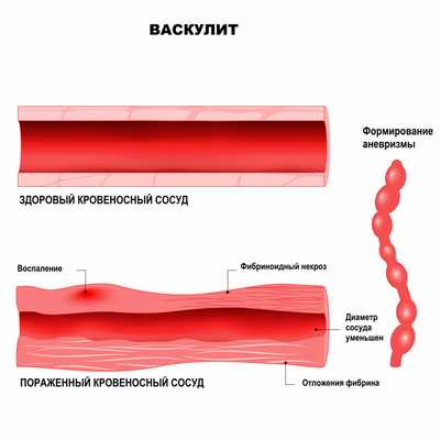 Аллергический васкулит